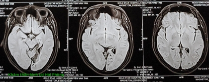 Hội chứng bệnh não sau có hồi phục (PRES) và hội chứng co thắt mạch não có hồi phục (RCVS).